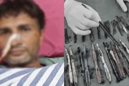 ವ್ಯಸನಮುಕ್ತ ಕೇಂದ್ರಕ್ಕೆ ಸೇರಿದ ವ್ಯಕ್ತಿಯ ಹೊಟ್ಟೆಯೊಳಗಿತ್ತು 29 ಸ್ಟೀಲ್‌ ಚಮಚಗಳು, 19 ಟೂತ್‌ ಬ್ರಷ್‌ಗಳು, 2 ಪೆನ್‌…!